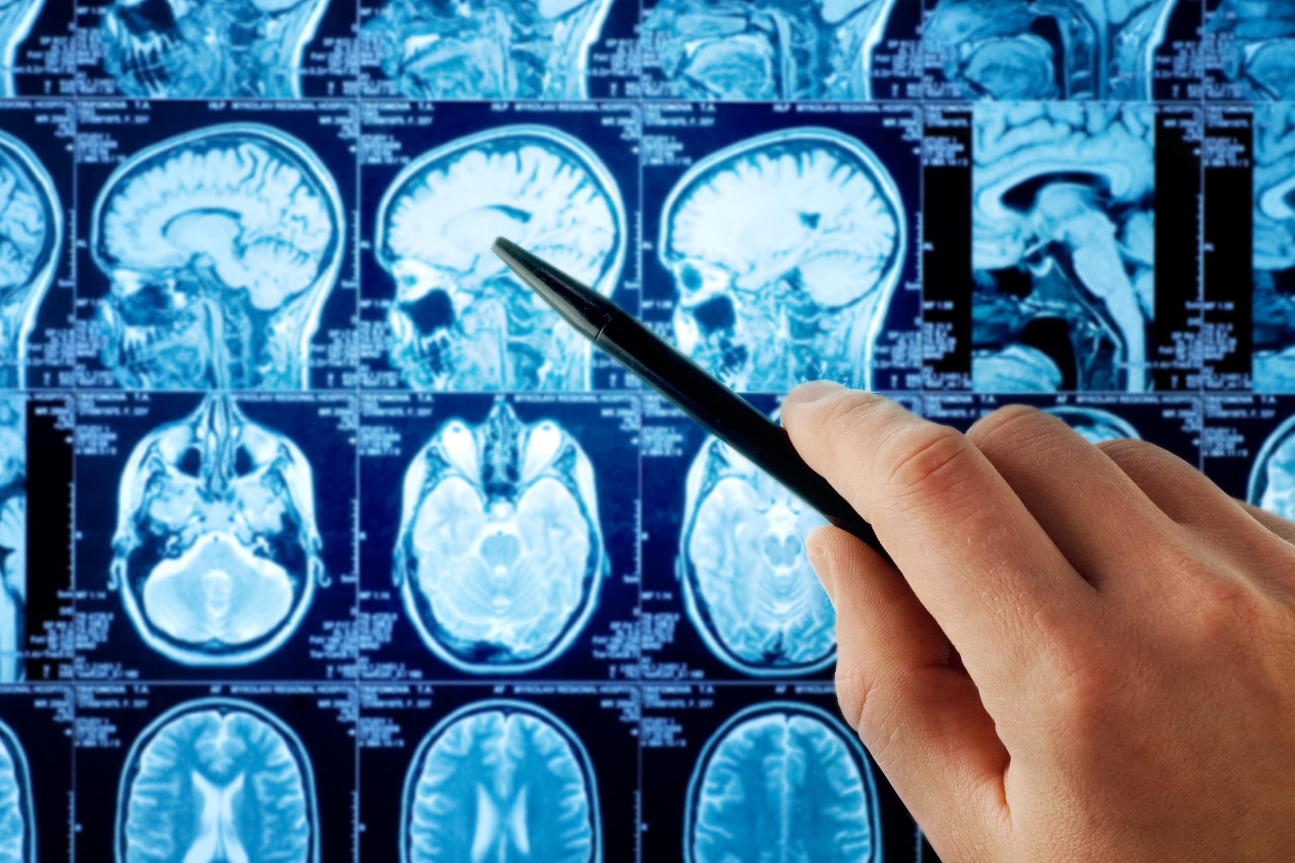 Personalized therapeutic vaccines to treat brain cancer