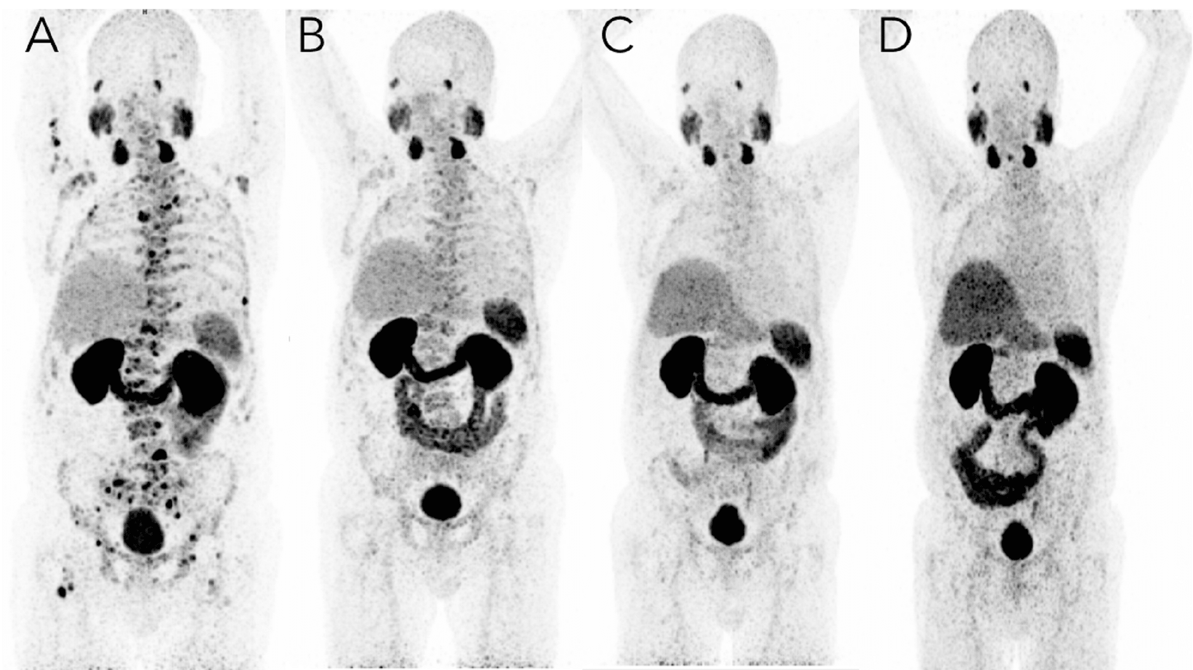 Innovative treatment for prostate cancer shows long term success